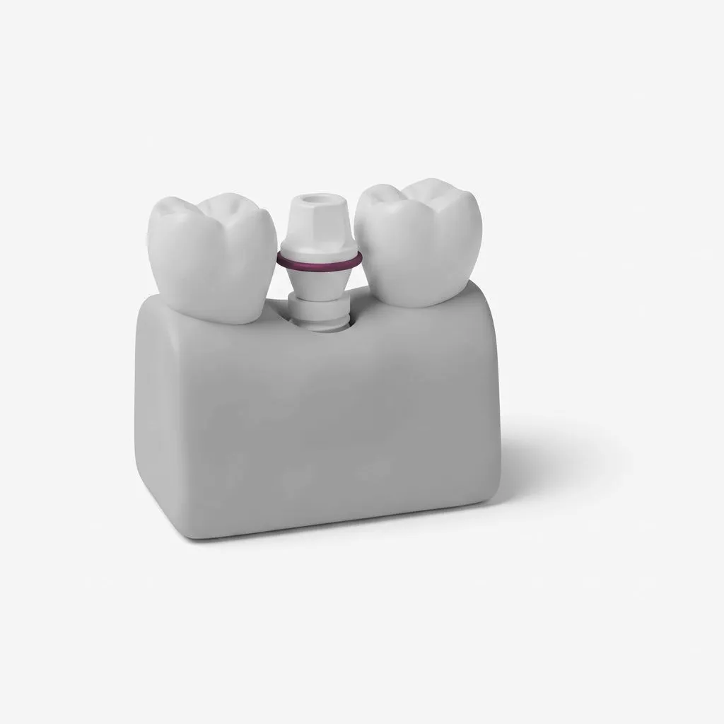Sofortimplantat in Berlin: Zahn raus, Implantat rein – an einem Tag?