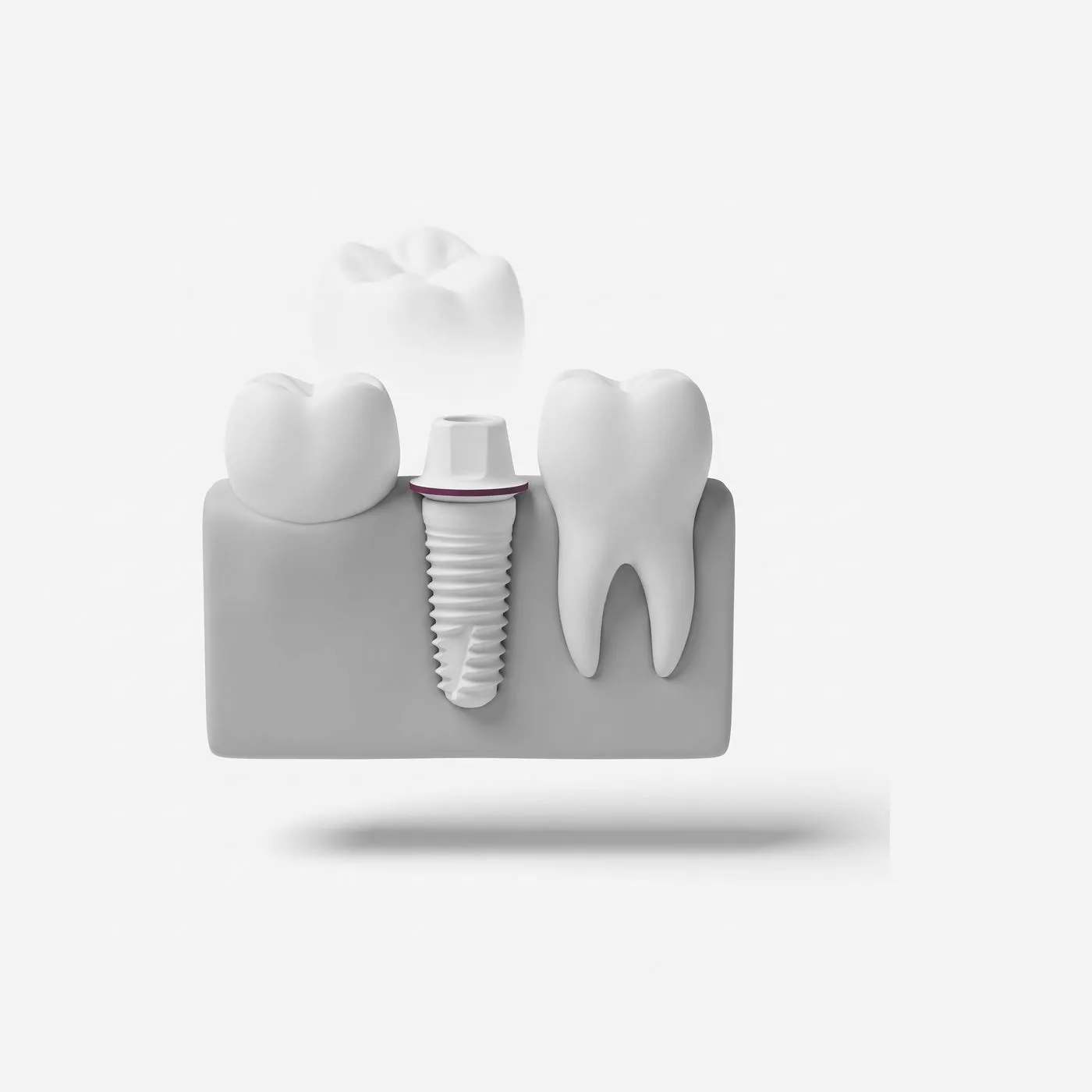 Sofortimplantat in Berlin: Zahn raus, Implantat rein – an einem Tag?